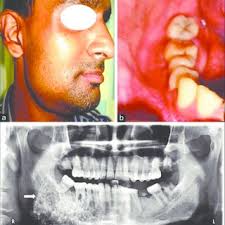 PDF) Intraosseous calcifying epithelial odontogenic (Pindborg) tumor: A  rare entity