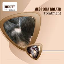 Pin On Alopecia Areata