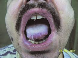 Image result for lichen planus on tongue)
