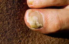 6 natural ways to deal with nail fungus