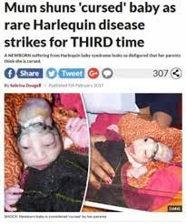 奇病・ハーレクイン型魚鱗癬の赤ちゃん誕生も人々は「ヒンドゥーの神の化身」（印） (2017年2月11日) - エキサイトニュース