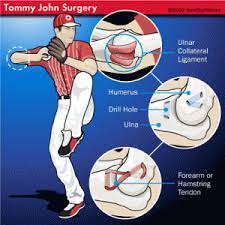 The procedure has become synonymous with. Tommy John Surgery And The Facts Orthopedic Specialists Of Seattle