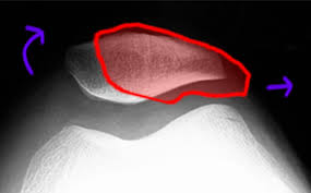 Image result for Patellar Tilt Test