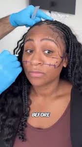 Woman shows off her before and after plastic surgery transformation…. 🧐  (Video In Comments)