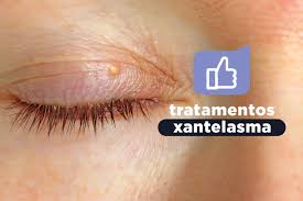 Image result for xantelasma