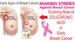 If the fight against the disease begins at the third stage, healing is possible only in 40% of patients. Evolving Role Of Zoledronic Acid In Early Breast Cancer