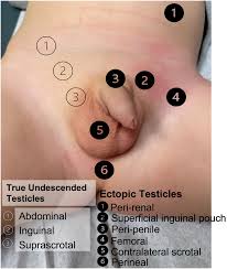 Image result for Undescended Testicle