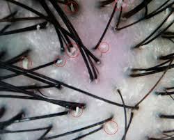 Excess sebum is closely related to hair loss. Hair Loss Healthy Lives