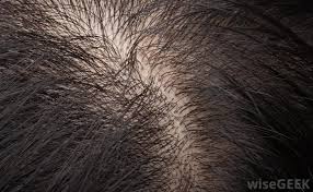 An itchy scalp can indicate many things, from oily, dirty hair that needs to be washed thoroughly to skin irritation that may need to be treated using a topical medication. What Is The Connection Between Itching Scalp And Hair Loss