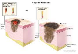 Since melanoma has a higher risk of metastasizing, staging is done to learn how dense or thick the growth or tumor is, how deeply it has affected the skin, whether the cancer has spread to other parts of the body, and whether the tumor is ulcerated, meaning it has broken through the skin. Melanoma Treatment Pdq Patient Version National Cancer Institute