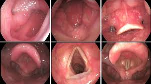 Image result for Reflux Laryngitis
