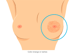 Here are the potential breast cancer symptoms to watch out for. Breast Cancer Signs Symptoms Stages Treatment About Risk Factors Ashray