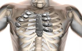 According to the university of kansas medical center, the spleen can be found in the upper left quadrant of. Cancer Patient Receives 3d Printed Ribs In World First Surgery Csiroscope