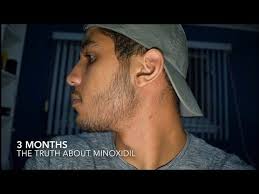 Its use requires patience and even after reaching the results, it is advisable to use minoxidil so that the results remain permanent. Minoxidil Side Effects Results Amp The Truth Of Minoxidil Beard Growth 3 Months Ihazadream Youtube Minoxidil Beard Minoxidil Beard Growth