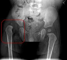 Image result for Hip XRay