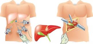 как избавиться от полипов в желчном пузыре народными методами Polipy V Zhelchnom Puzyre Simptomy Lechenie Operaciya