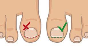 At times people like to cut in the corner of the toenail thinking they are avoiding an ingrown toenail, but they are actually creating. Preventing Ingrown Toenails How To Prevent Ingrown Toenails