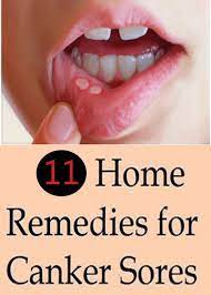 11 Best Home Remedies For Canker Sores I Never Thought I Could End My Angular Cheilitis Infection Canker Sore Remedy Home Remedy For Canker Sores Canker Sore