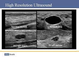 Can ultrasounds miss breast cancer? answered by dr. Ucla Health On Twitter What Does Breastcancer On An Ultrasound Look Like Uclamdchat Http T Co Rayischnso Http T Co 9ptl6l0i6l