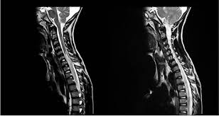 Fokale anfälle und epilepsie können auftreten. Pediatric Acute Transverse Myelitis Neurosciences Journal