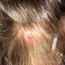 Image result for infected tick bite