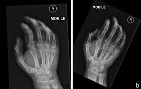 About 1,000 cases of gas gangrene are reported yearly in the united states. Clostridium Perfringens Gas Gangrene At A Wrist Intravenous Line Insertion Bmj Case Reports