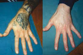 We treat all types of tattoos those that are professional, amateur and traumatic. Gp Sets Up Tattoo Removal Service Gponline