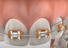 Braces Care | True North Orthodontics