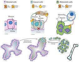 Antioxidant vitamin and mineral supplementation and prostate cancer prevention in the su.vi.max trial. Frontiers Glucose Metabolism In The Progression Of Prostate Cancer Physiology