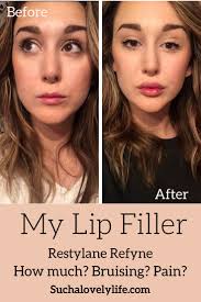 There is a range of prices within the juvederm family, depending on which filler is used (volbella, ultra, ultra plus, voluma, etc). Restylane Refyne Lip Filler Before After 1 Syringe Lip Fillers Lip Injections Lip Fillers Cost