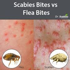 Image result for flea bites
