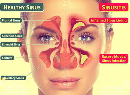 Endoscopic sinus
