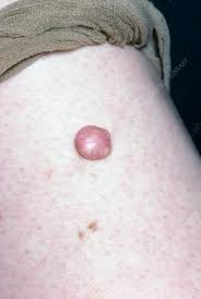 Image result for Nodule