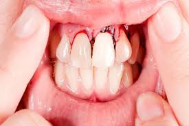 Tooth extraction is the removal of a tooth from its socket in the bone. Problems With A Damaged Tooth Sedation And Implant Dentistry Las Vegas