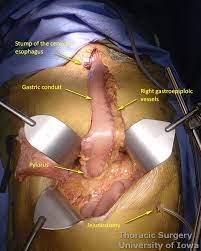 More images for mckeown esophagectomy incision » Esophagectomy Transhiatal Laparotomy With Cervical Anastomosis Iowa Head And Neck Protocols