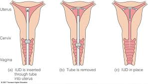 Interested in an iud as a form of convenient birth control? What To Expect When Getting An Iud Teen Health Source