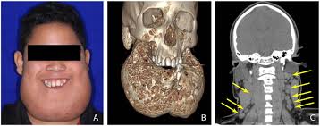 A 14-year-old boy exhibited bilateral enlargement of the mandible,...