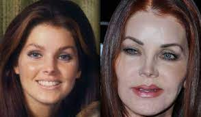 Priscilla presley has confirmed reports she received botched treatment from an unqualified plastic surgeon. Priscilla Presley Plastic Surgery Went Horribly Wrong