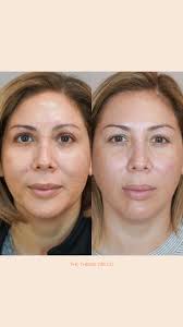 Vivace Rf Microneedling Before and After