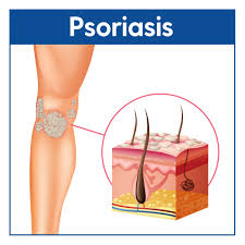 Image result for psoriasis