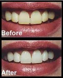 Baking soda, a mild abrasive. Before And After Homemade Teeth Whitening Recipe With Baking Soda Bellatory