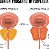 For people with advanced prostate cancer, asco recommends that 1 or more of the imaging tests below be done to provide more information about the disease and help plan the best treatment. 1