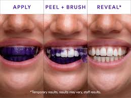 Amazon.com: Hismile V34 Whitening Strips, Teeth Whitening Strips, Purple  Tooth Whitening, Purple V34 Whitening Strips, Tooth Stain Treatment,  Combining Whitening and Colour Correction : Health & Household