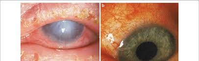 Image result for Vernal Conjunctivitis