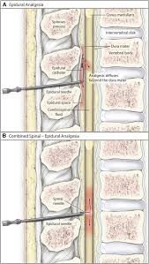 Image result for Active Labor Anesthesia