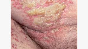 Image result for sore skin in the groin area