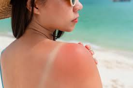 Image result for Sunburn