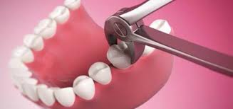 Chirurgie Extractii