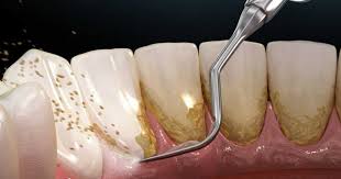 Image result for Plaque