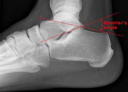 Image result for Ankle XRay